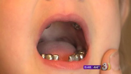 Dentofobie: Angst voor de tandarts